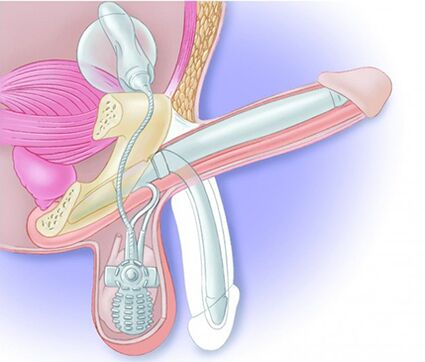 Dzimumlocekļa protēze atjaunos erekciju un padarīs dzimumlocekli lielāku