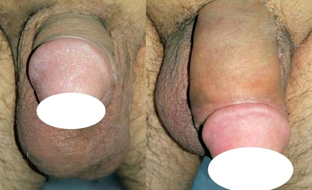 fotogrāfijas pirms un pēc dzimumlocekļa paplašināšanās